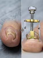 Nail Repair Tools